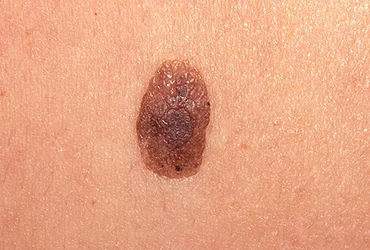 Queratose Seborreica
