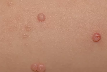 Tudo Sobre Molusco Contagioso: Sintomas, Transmissão e Tratamento
