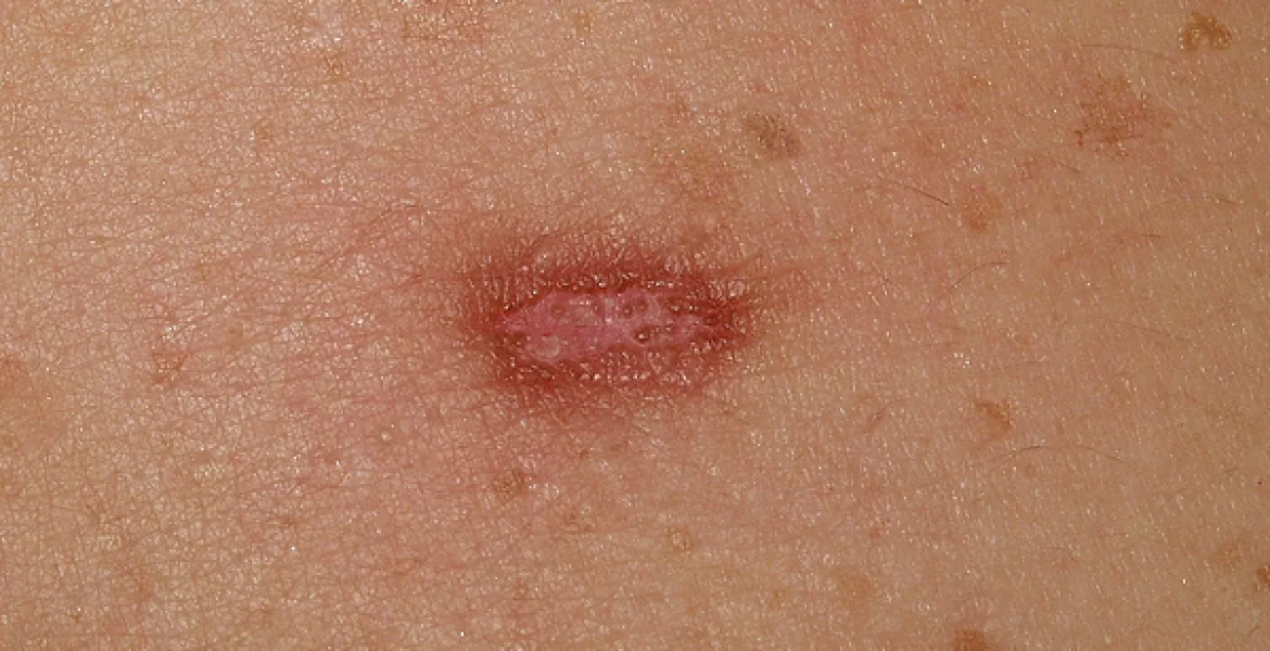 Dermatofibroma