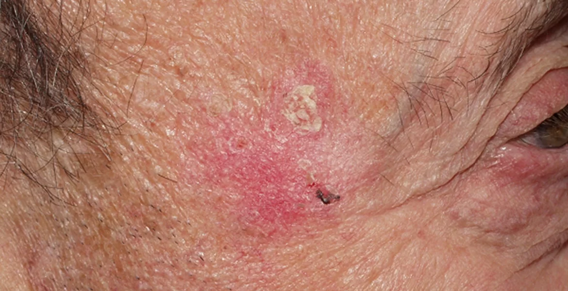 Queratoses Actínicas: O Que São e Como as Podemos Prevenir?