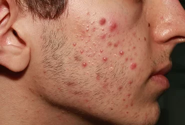 ACNE